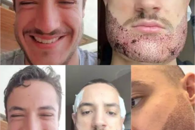 “24-Year-Old Student’s Shocking End: How a Failed Beard Transplant Led to Tragedy – Why Did It Go Horribly Wrong?”